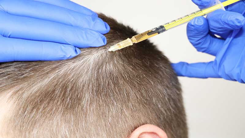 آیا مزوتراپی مو برای ریزش ارثی مؤثر است؟