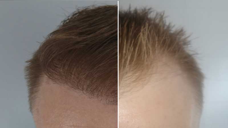 اصلاح موی سر پس از کاشت مو 
