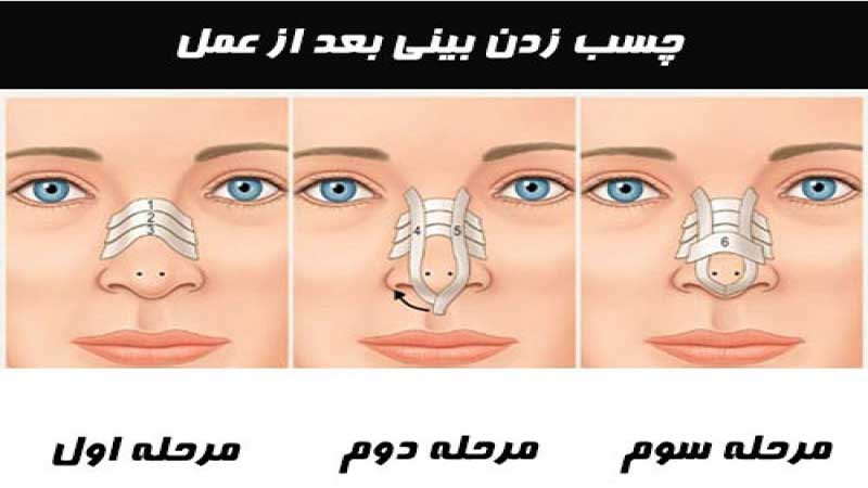 نحوه چسب زدن بینی بعد از عمل جراحی بینی
